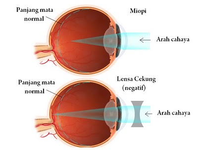 Mata seperti organ tubuh yang lain juga dapat mengalami kelainan 